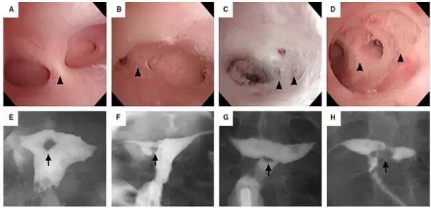 宫腔镜羊膜移植术多久能下地,重度宫腔粘连试管成功率高吗