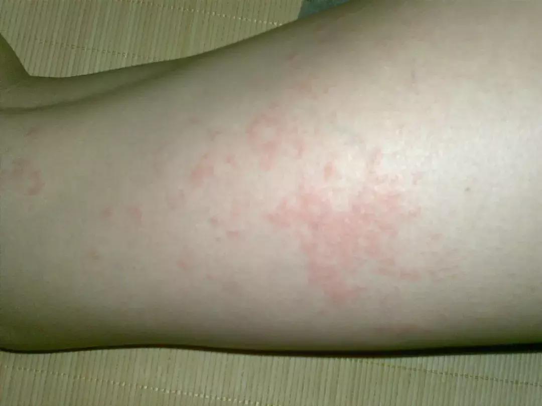 药物过敏为什么只过敏在脸上,药物过敏后续