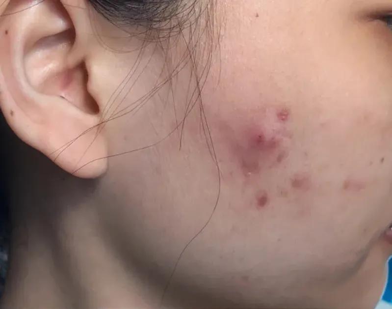 脸上长痘反反复复如何有效祛痘,脸上反反复复长痘怎么处理