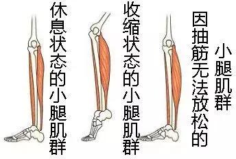 晚上小腿抽筋好痛该如何缓解,半夜抽筋小腿很疼要怎样止痛