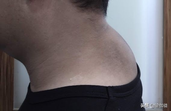 颈椎富贵包怎么消除最有效方法,怎样快速消除颈椎的富贵包