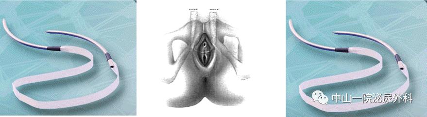 中山一院梁月有教授简介,压力性尿失禁中医能治好吗