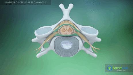 心绞痛和颈椎病鉴别,颈椎型心绞痛怎么治疗
