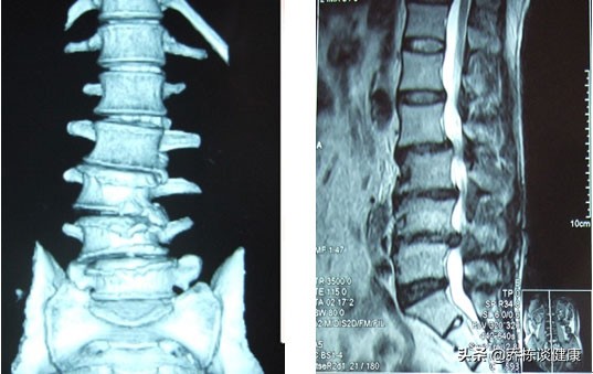 频繁腰痛十多年，吃药到胃痛，贴膏药过敏，还该怎么办？