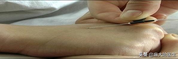 打静脉针,静脉扎针不回血是怎么回事