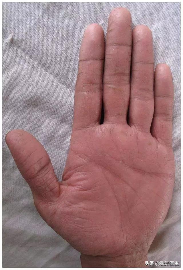 手不干活都裂开了，有什么好办法吗？