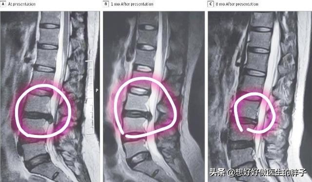腰间盘突出髓核会掉下来吗,腰间盘突出髓核掉进椎管