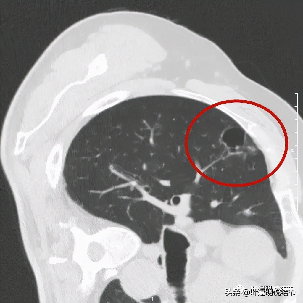 肺多发结节切除一个剩下的怎么办,无限纠结的肺小结节