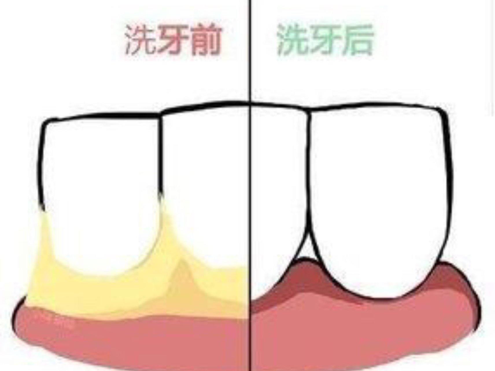 为什么洗完牙后牙缝会变大,牙医说洗牙后牙缝变大