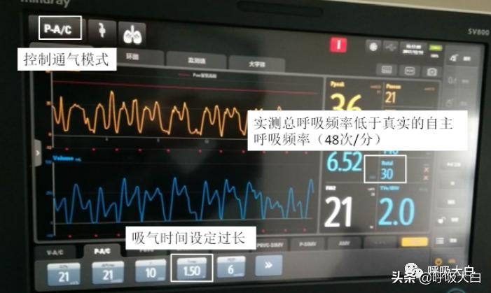 呼吸机设置：呼吸频率+吸呼比