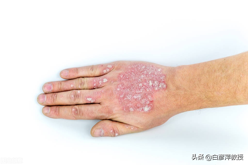 银屑病脸部保湿的护肤品,银屑病怎么保湿皮肤