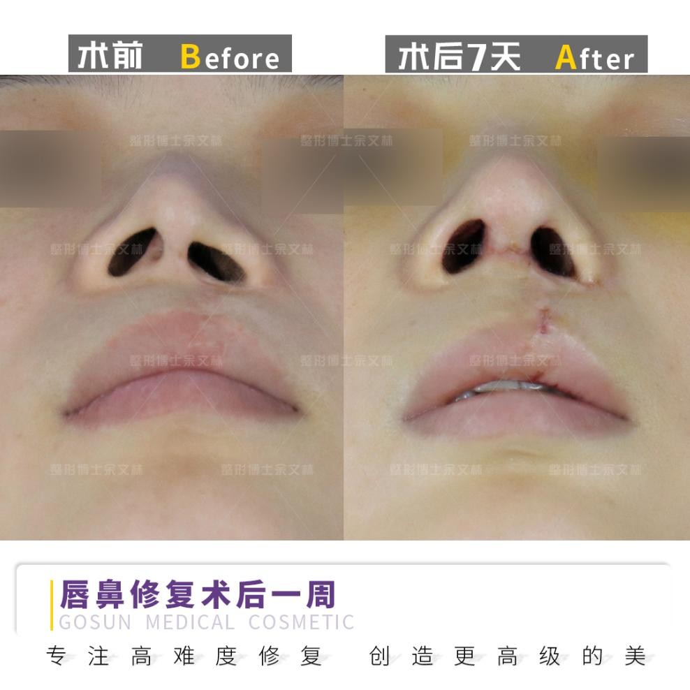 唇裂先牙齿矫正还是鼻畸形先矫正,唇裂畸形的手术修复