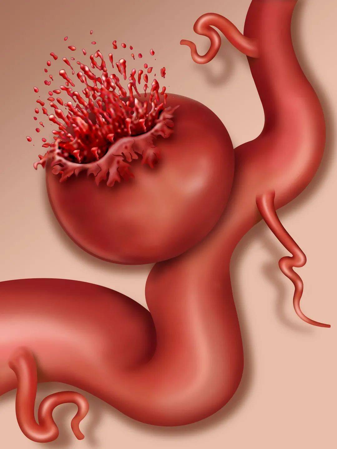 动脉瘤蛛网膜下腔出血术后并发症,动脉瘤导致蛛网膜下腔出血严重吗