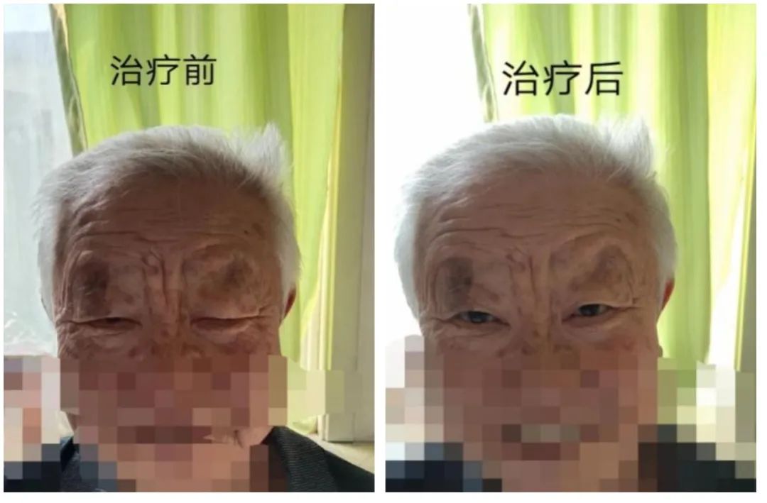 病态眼皮抬不起,眼皮抬不起来是什么病的前兆