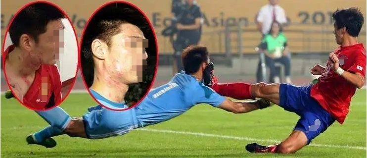 足球是一个高危的职业,足球高危职业