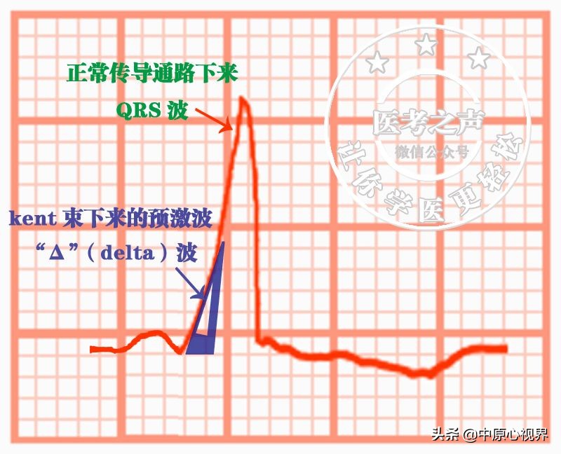 护考几种常见的心电图,常见的心电图图形分析