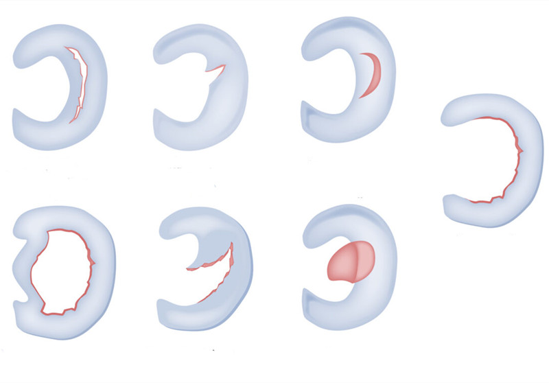 半月板部分切除对膝盖的影响,膝盖没有半月板