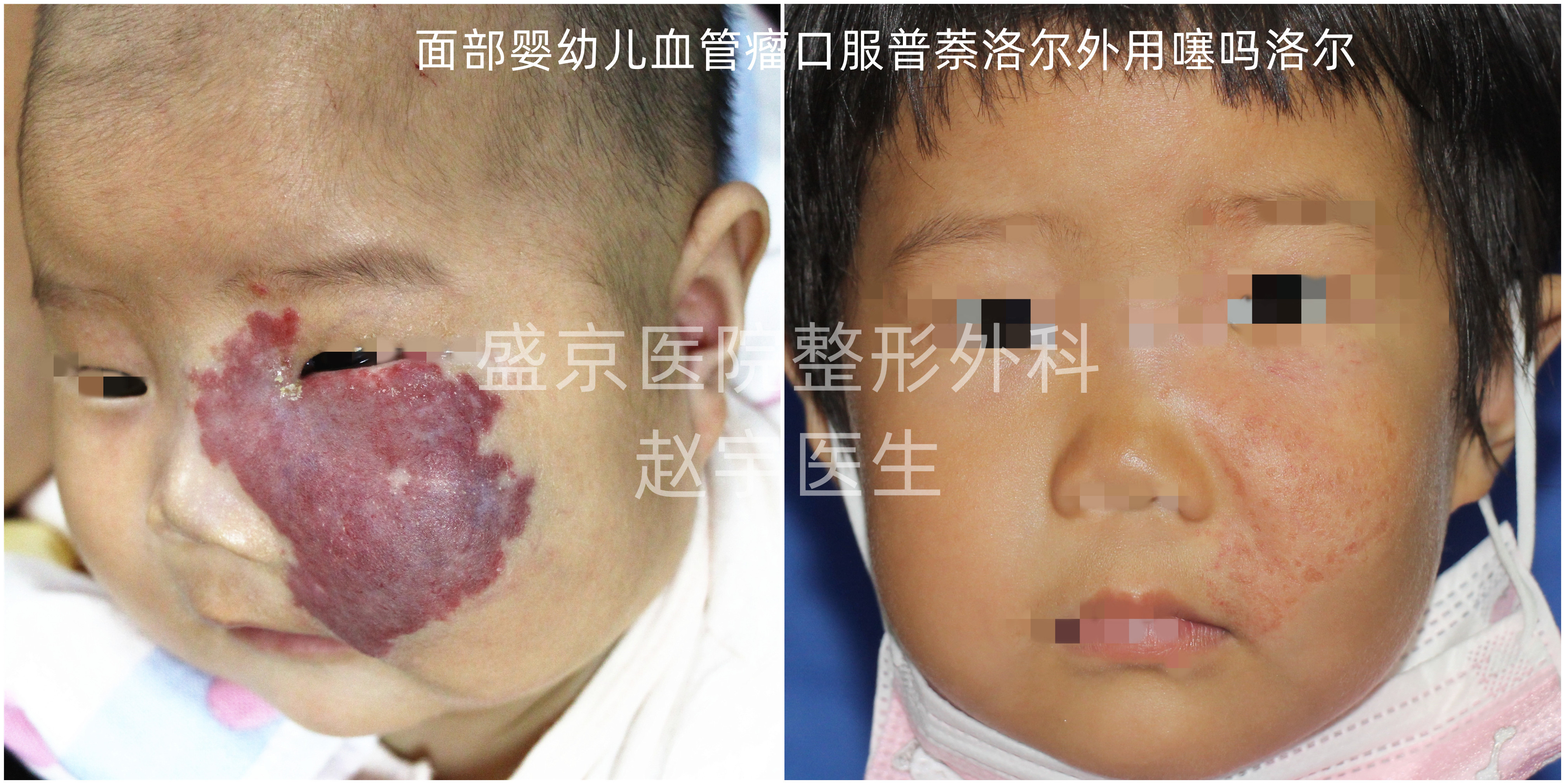 婴儿红胎记,婴儿红胎记图片大全