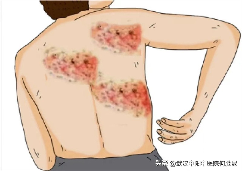 身上长水疱很疼,身上长水泡怎么回事