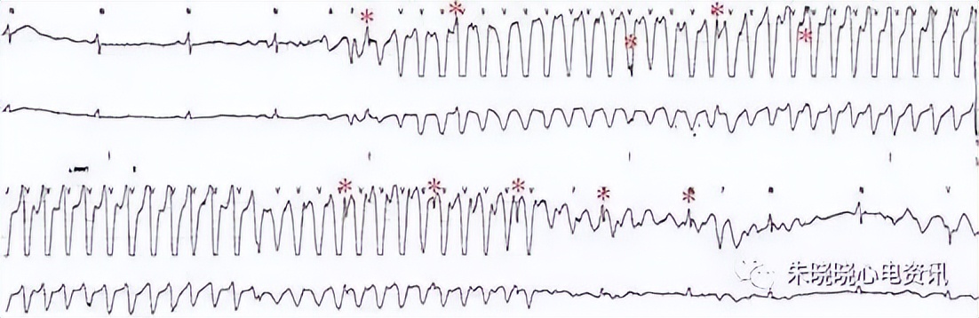 心电图机干扰信号过大的原因,心电伪差一般是指哪些干扰