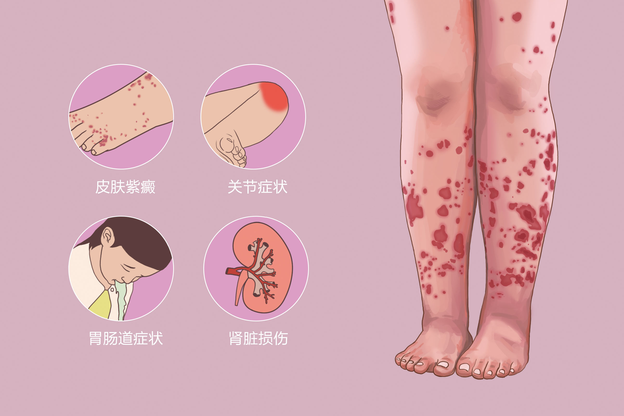 大腿根部顽固性紫癜,反复发作过敏性紫癜怎么治疗断根