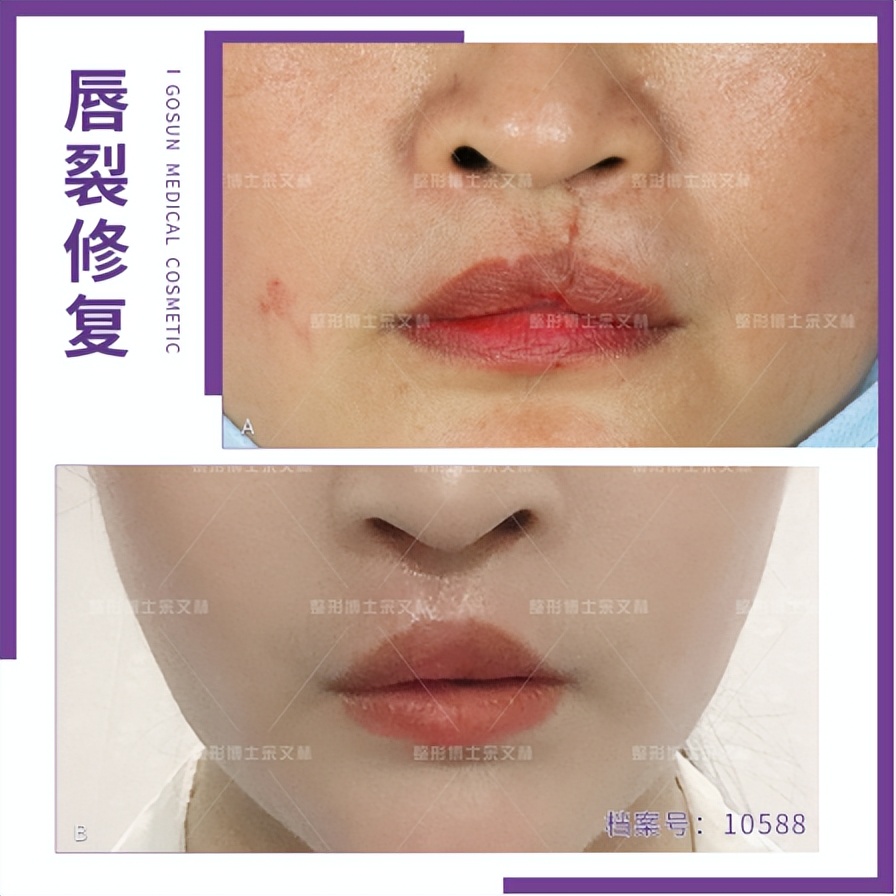 唇裂疤痕修复,唇裂修复后的疤痕怎么处理