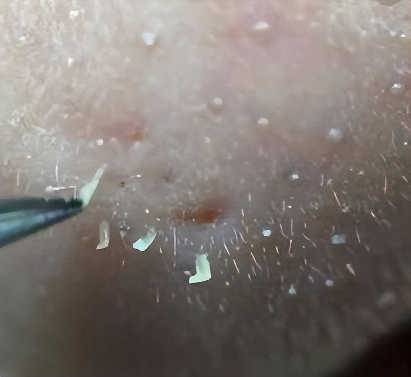 毛孔堵塞毛孔发黑怎样清理,毛孔长螨虫堵塞毛孔怎么办