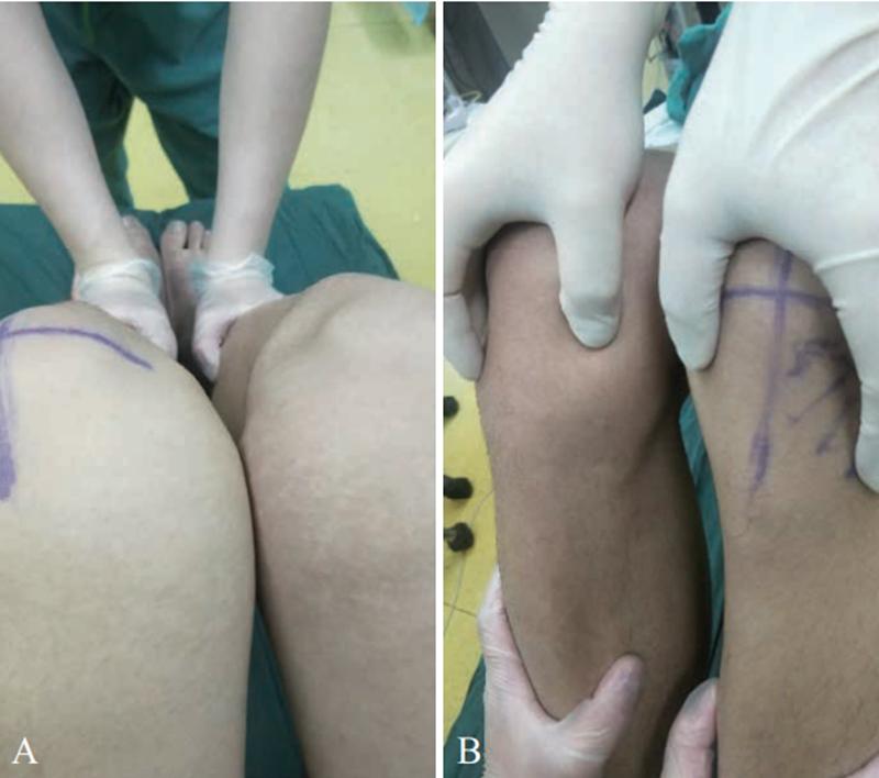 膝关节前交叉韧带损伤怎么治,十字交叉韧带损伤如何解决