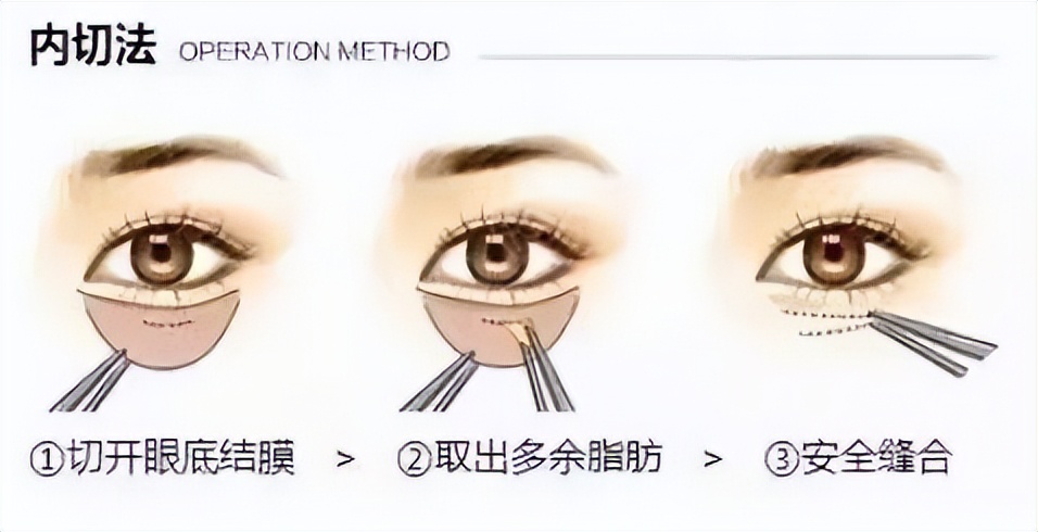 有效去黑眼圈和泪沟方法,黑眼圈泪沟抗衰老