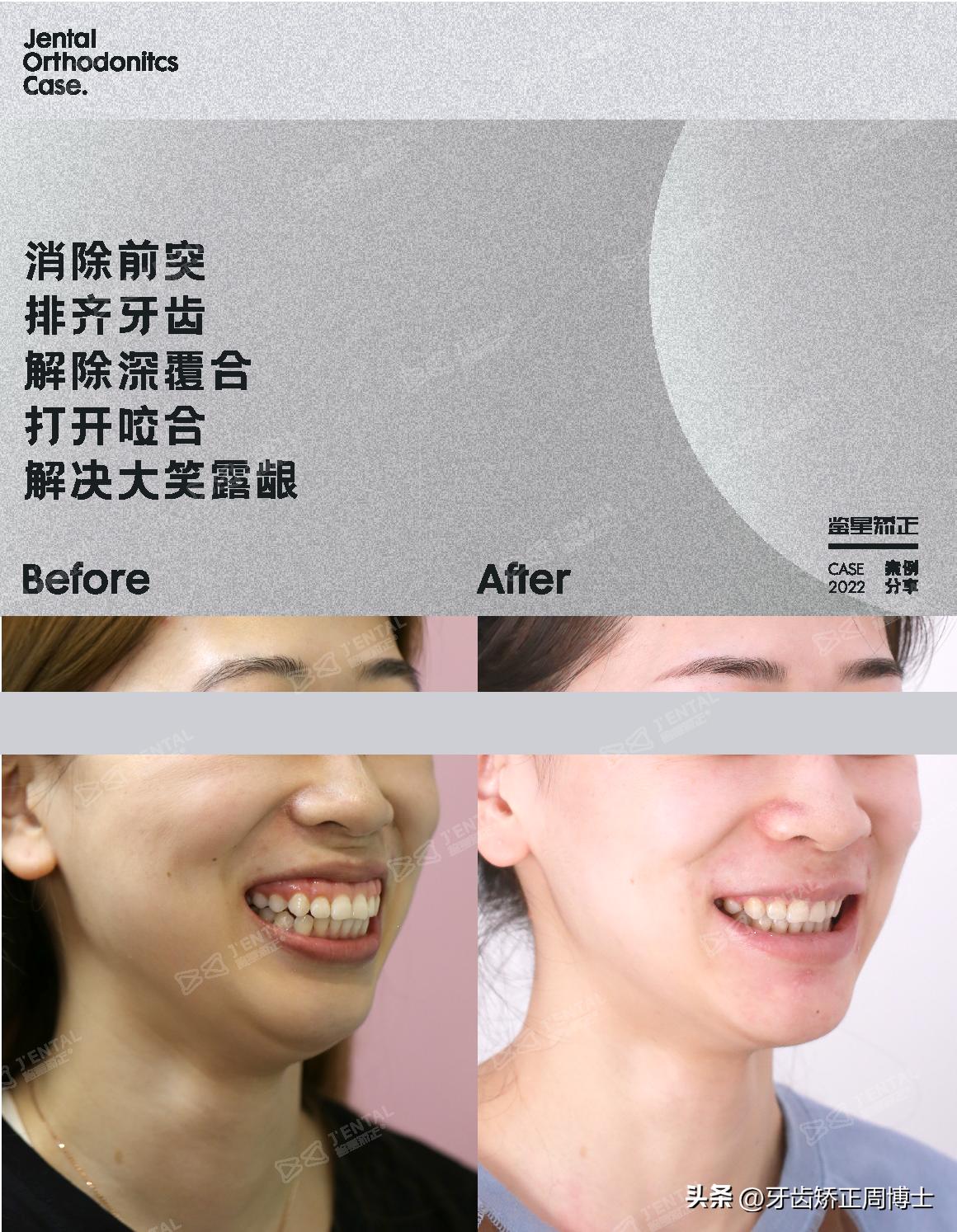 骨性前突正畸后多长时间有效果,牙性下巴后缩可以戴牙套改善吗