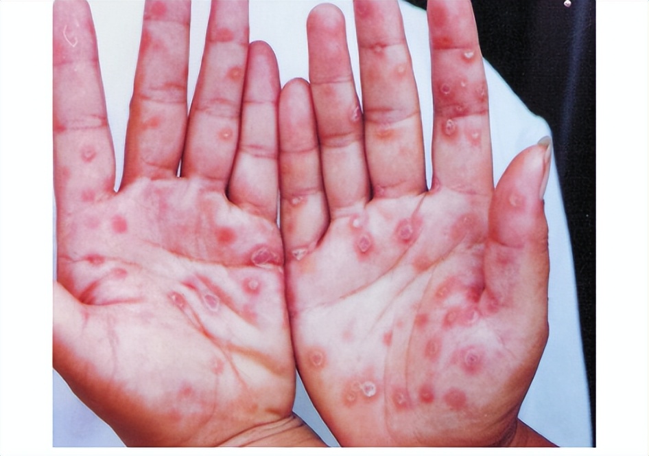 嫖娼后，怎么知道自己有没有染病？