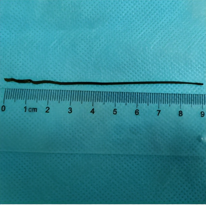 误吞异物成功案例,误吞硬物怎么救