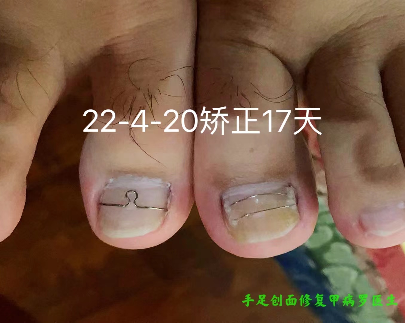 甲沟炎十年,有史以来最严重的甲沟炎