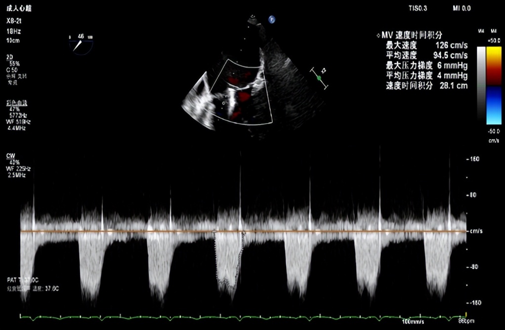 郑州大学第一附属医院心脏瓣膜,新技术治疗心脏瓣膜病