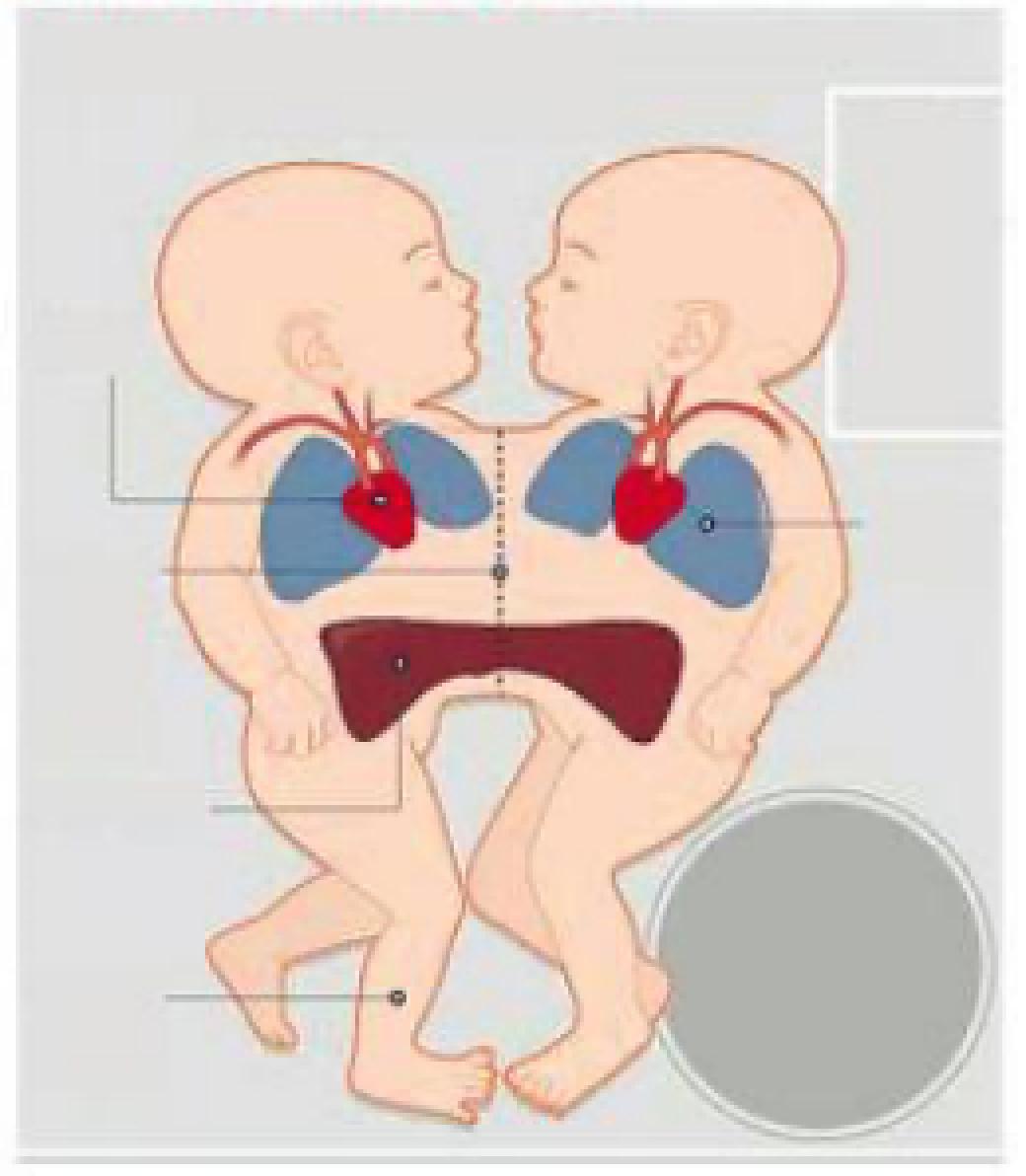 连体婴是不是有的共用一个大脑,两个大脑控制一个身体