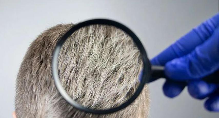 长白发的原因和解决方法,30岁突然长白发什么原因