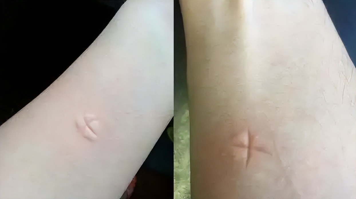 为什么你会独得蚊子恩宠,自打入冬以来独得蚊子恩宠