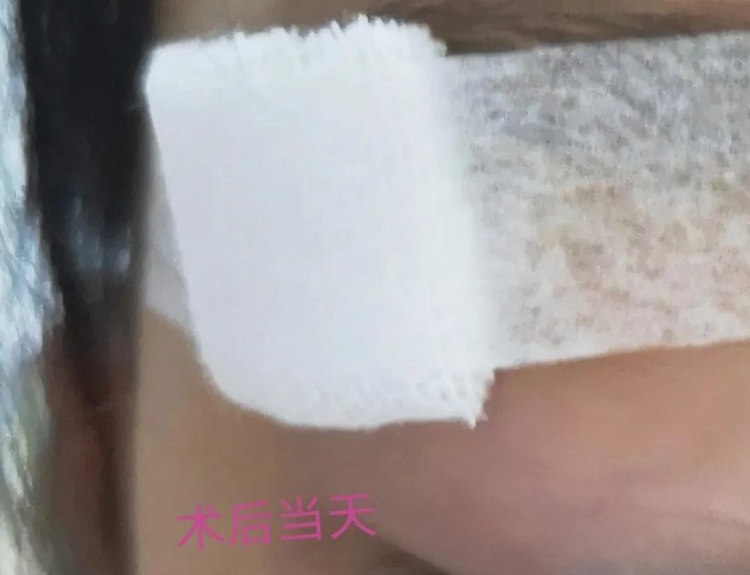 皮脂腺囊肿挤出囊袋,皮脂腺囊肿切除手术