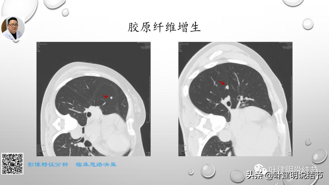 在《一脉阳光》呼吸影像诊断专题培训班上的讲课PPT（第一部分）