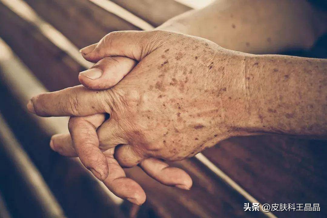 色斑用任何方法都祛不掉怎么办,色斑应该治吗