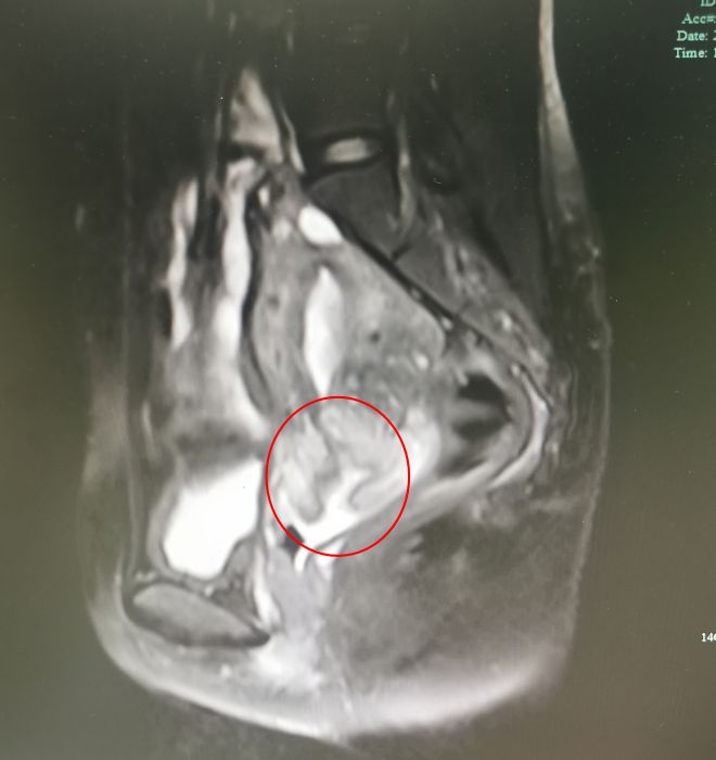 河南23岁宝妈大出血,28岁宝妈吃鸡蛋吃出宫颈癌