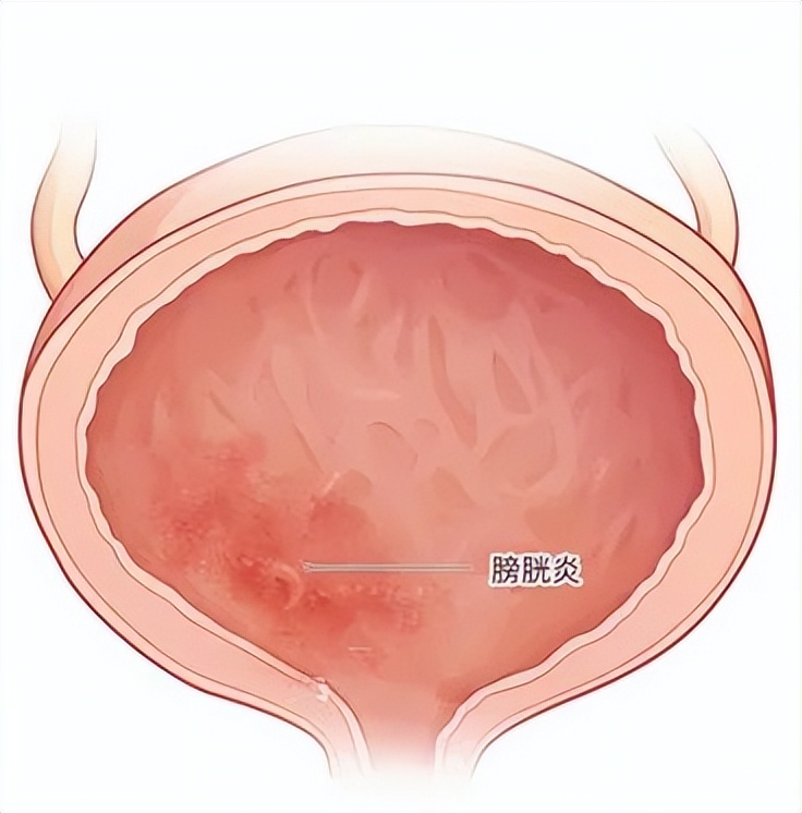 “小”膀胱“大”烦恼哪些症状说明是受伤​