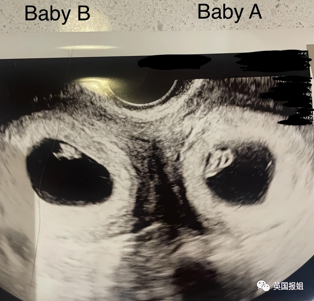 女子双子宫同时怀胎,双子宫妇女怀孕的几率有多少