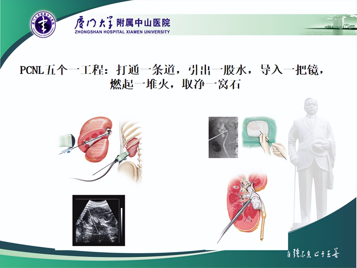 明知山有虎,偏向虎山行——肾斗士VS肾结石