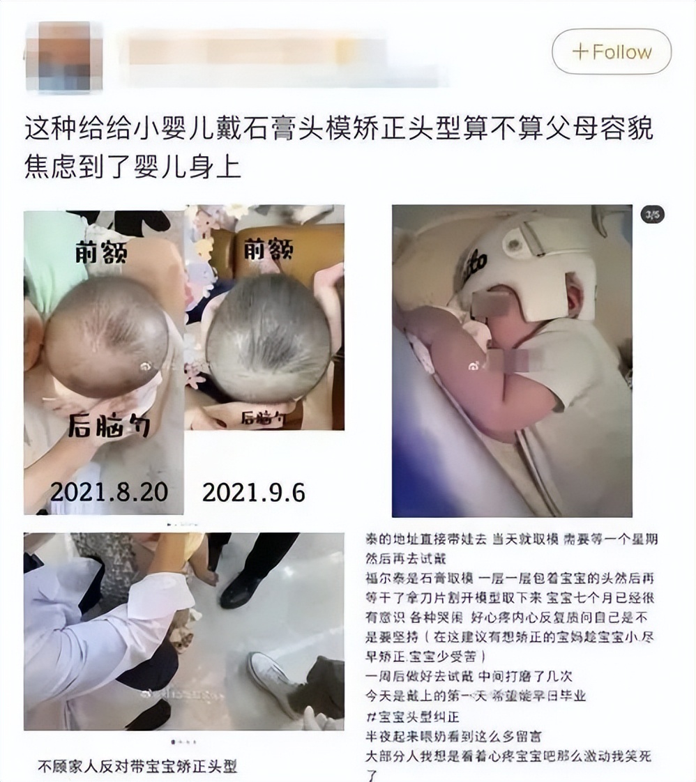 扁头通过训练变圆头是真的吗,儿童扁头头盔矫正