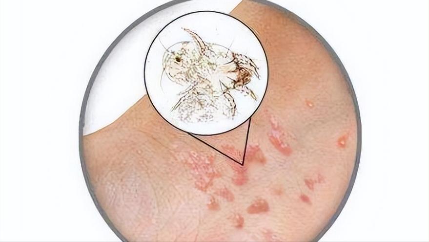 脖子下面长痘痘是什么原因,脸下面长痘痘是什么原因