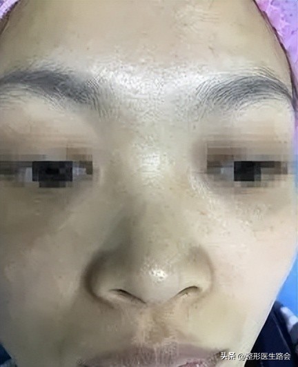 塌鼻子做什么样的鼻子安全,塌鼻子应该选择哪种隆鼻