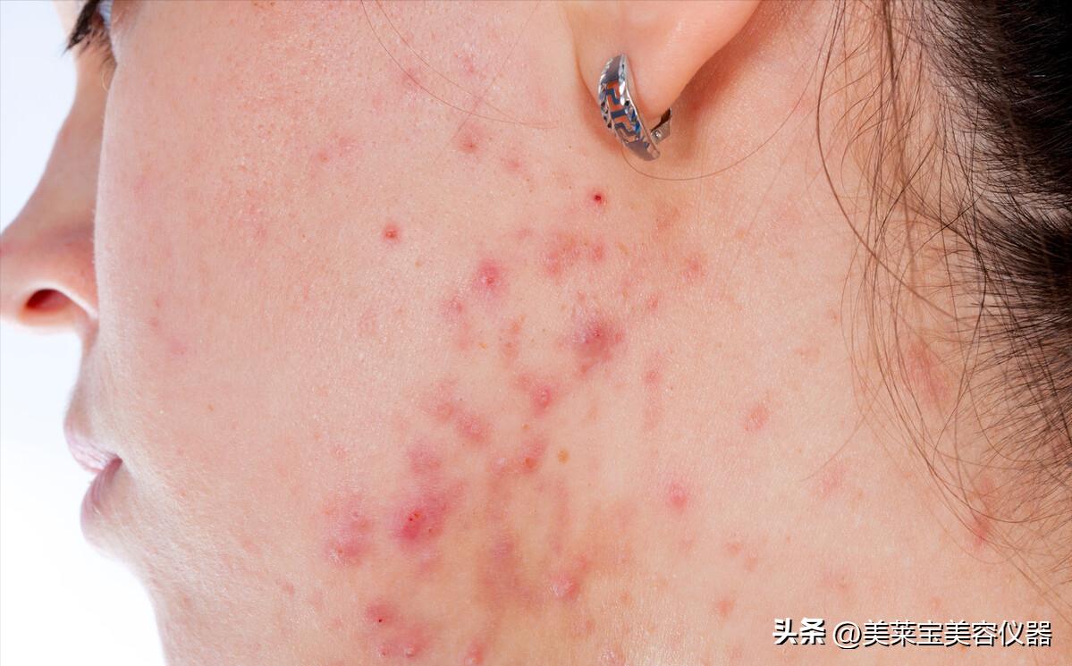腮边总是长硬痘是怎么回事,腮边长痘是因为啥怎么解决