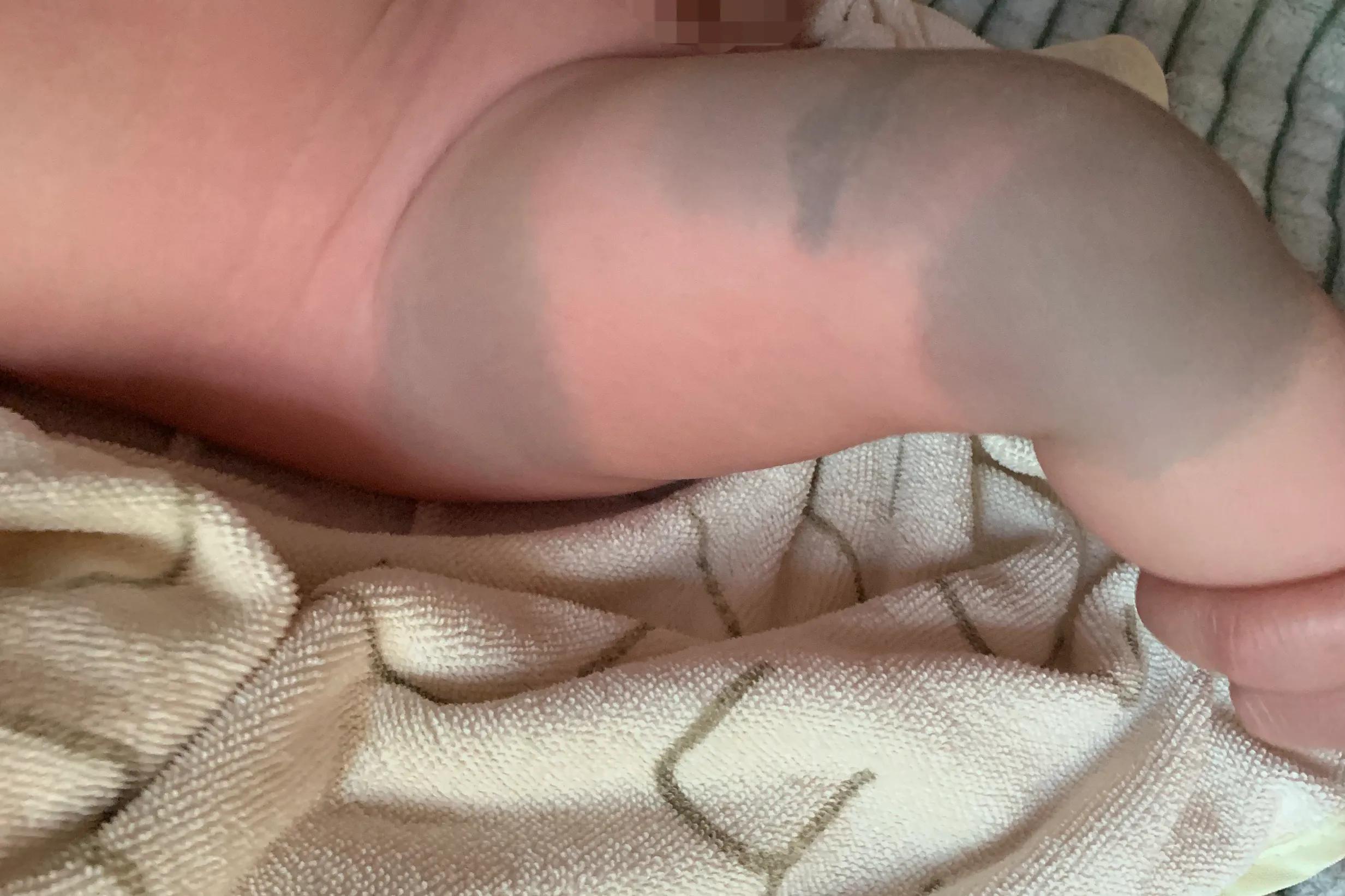 我家宝宝手上有胎记,宝宝身上有个胎记模糊不清