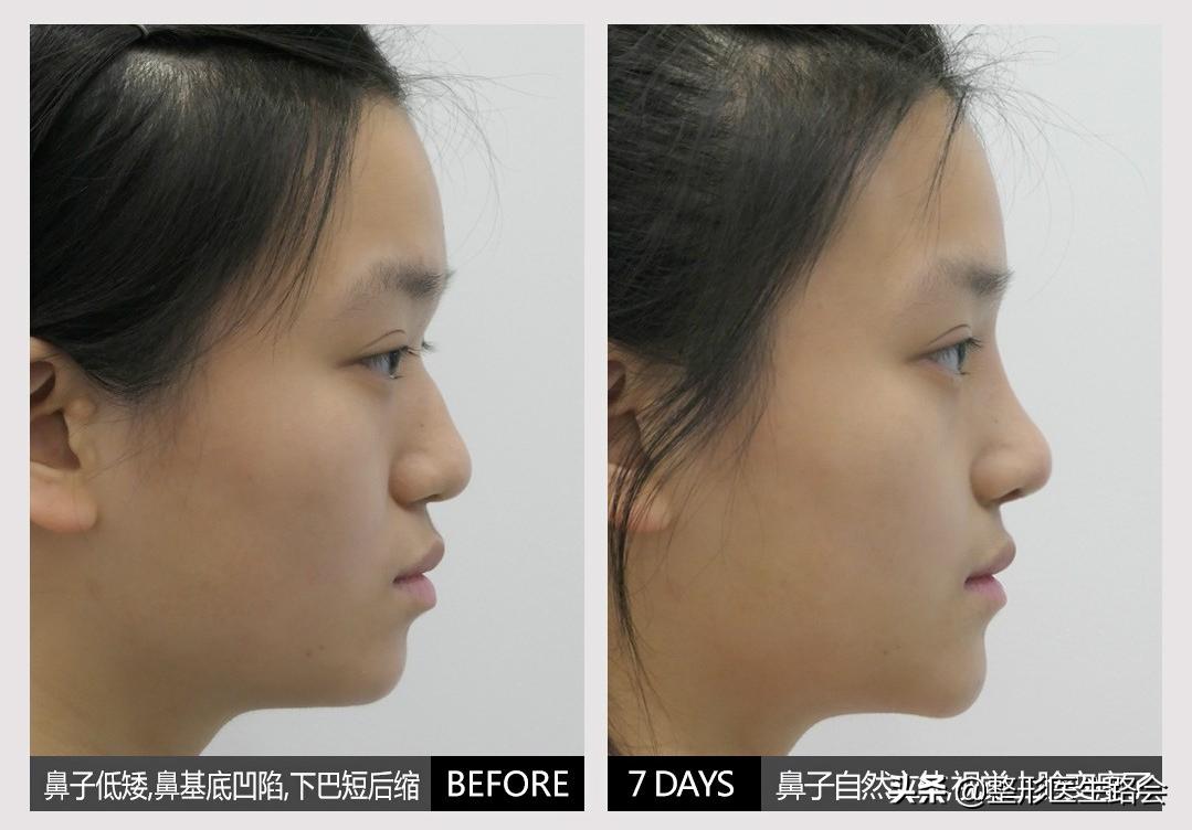 全脸整形记录恢复过程,女孩整形全过程